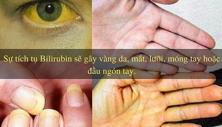 benh-vang-da